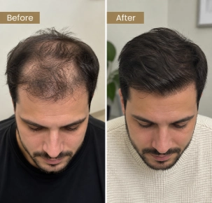 PRP Hair TReatment in Dubai Before and After