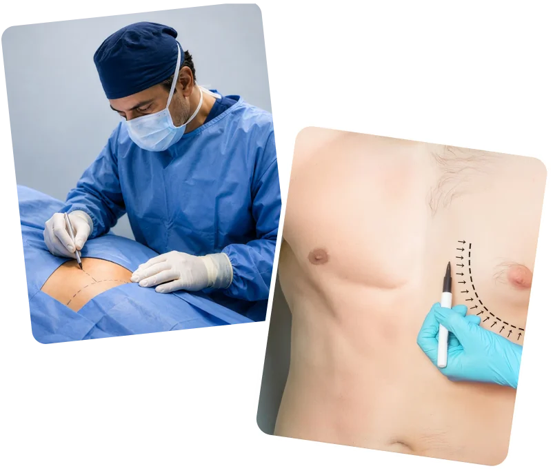 Preparation for Gynecomastia Surgery