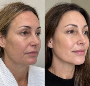 Profhilo Treatment in Dubai Before and After