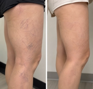 Spider Veins Treatment in Dubai Before and After