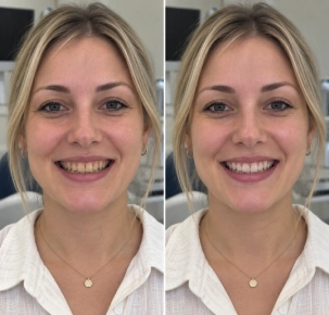Strain Removal in Dubai Before and After