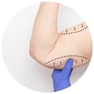 Traditional Arm Lift