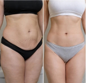 Tummy Tuck In Dubai Before and After