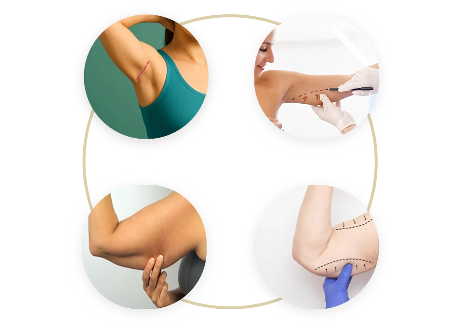 Types of Arm lift Surgery in Dubai