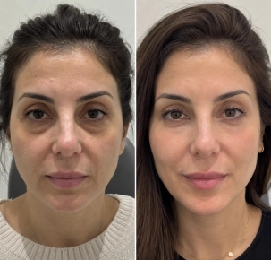 Under Eye Fillers in Dubai Before and After