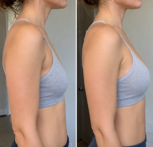 breast augmentation before and after pics
