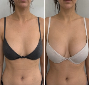 breast enlargement before and after