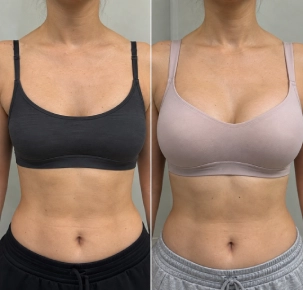 breast enlargement before and after photos