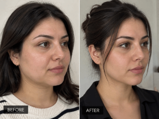 buccal fat removal cost