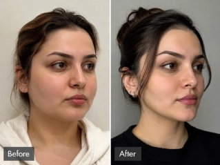 buccal fat removal dubai