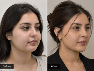 cheek fat removal