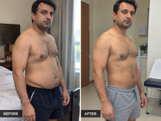 Abdomen and flank liposuction before and after