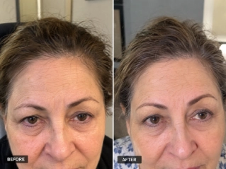 Before and After Brow Lift Surgery in Dubai