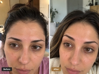 Before and After Brow Lift in Dubai