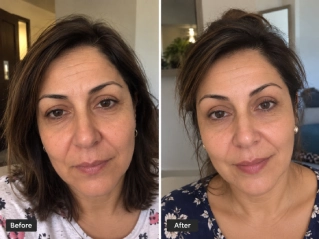 Before and After Brow Lift