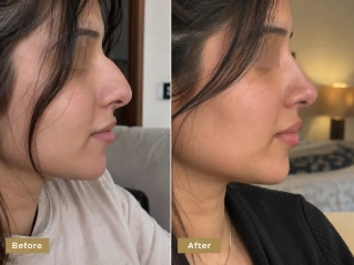 Before and After Nose Job Surgery in Dubai