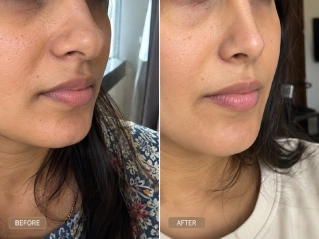 Before and After Rhinoplasty in Dubai