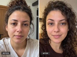 Brow Lift Before and After