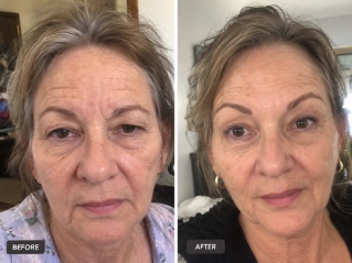 Brow Lift Surgery in Dubai Before and After