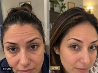 Brow Lift in Dubai Before and After