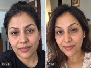 Brow Surgery Before and After