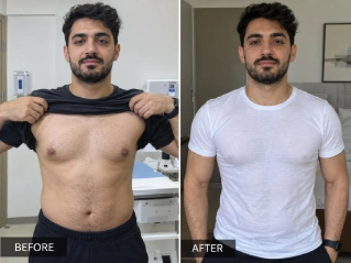 Male chest liposuction Before And After