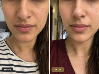 Rhinoplasty Surgery in Dubai Before and After