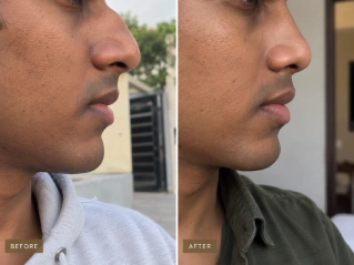 Rhinoplasty in Dubai Before and After