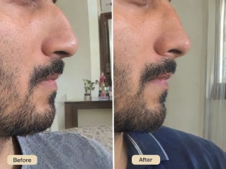 Surgery in Dubai Before and After Nose Job