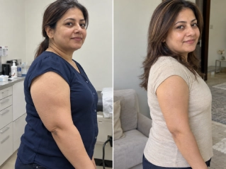 Upper arm liposuction Before And After